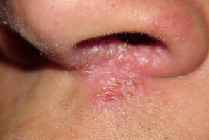 herpes nasal